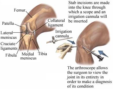 stab incisions are made into the knee with a scope to allow the surgeon to make a diagnosis by viewing the joint in its entirety